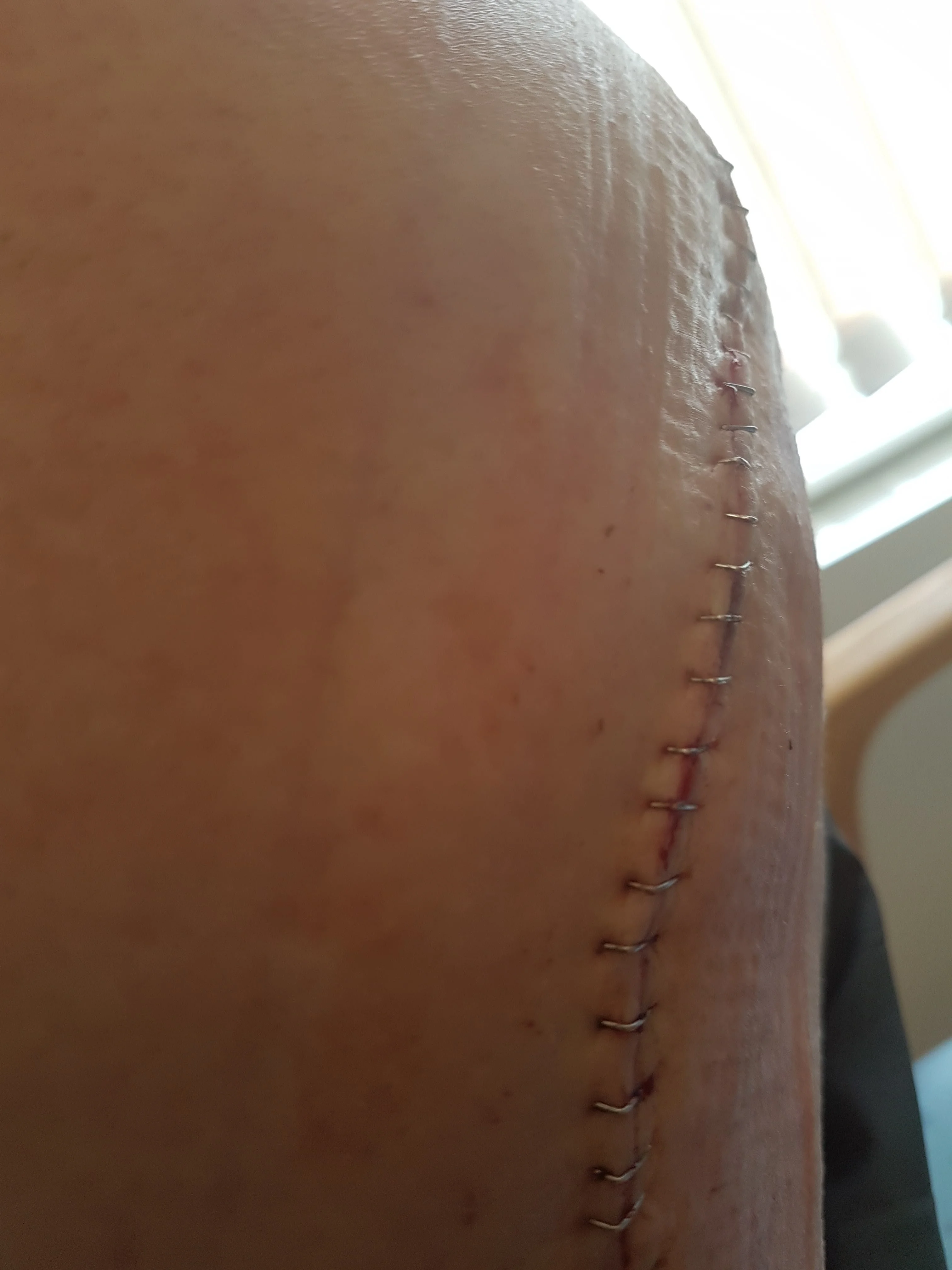 5 - Hip Scar.webp