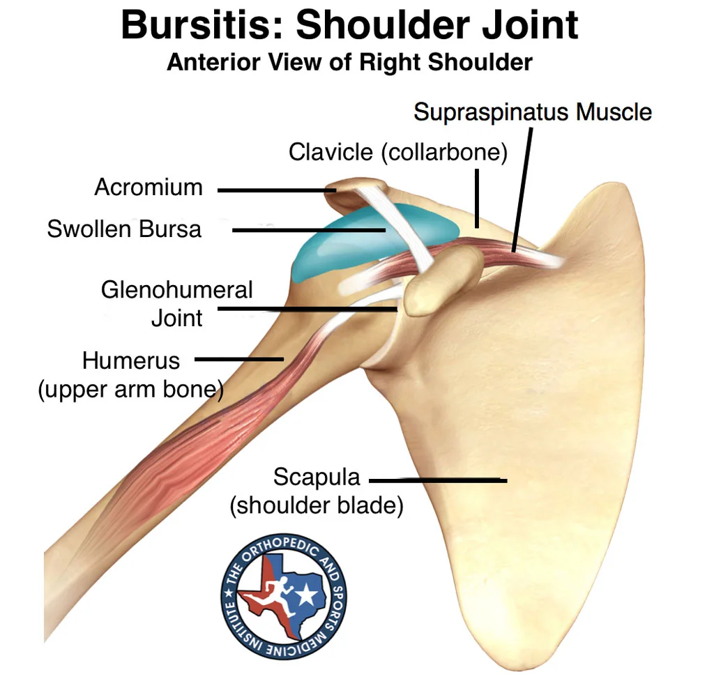 bursitis-shoulder-joint.webp