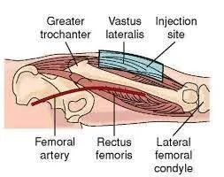 femoral_artery.webp