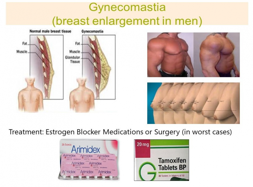 gynecomastia pictures excelmale.jpg