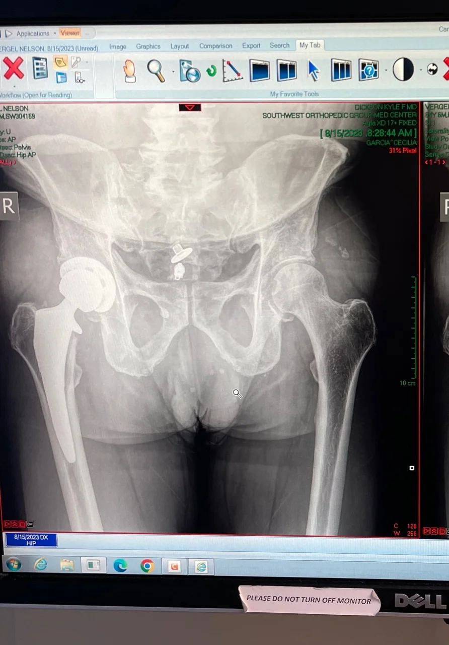 hip replacement.webp