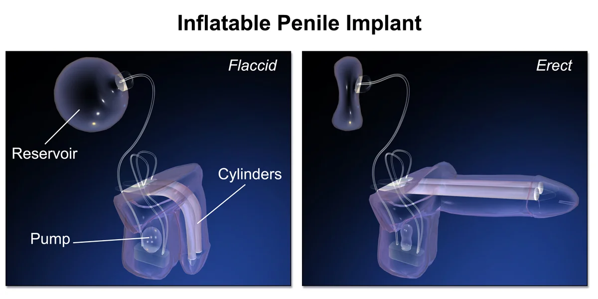 Penile_Implant.webp