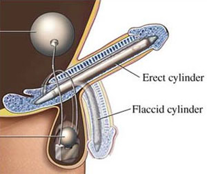 penileprosthesisexample.jpg