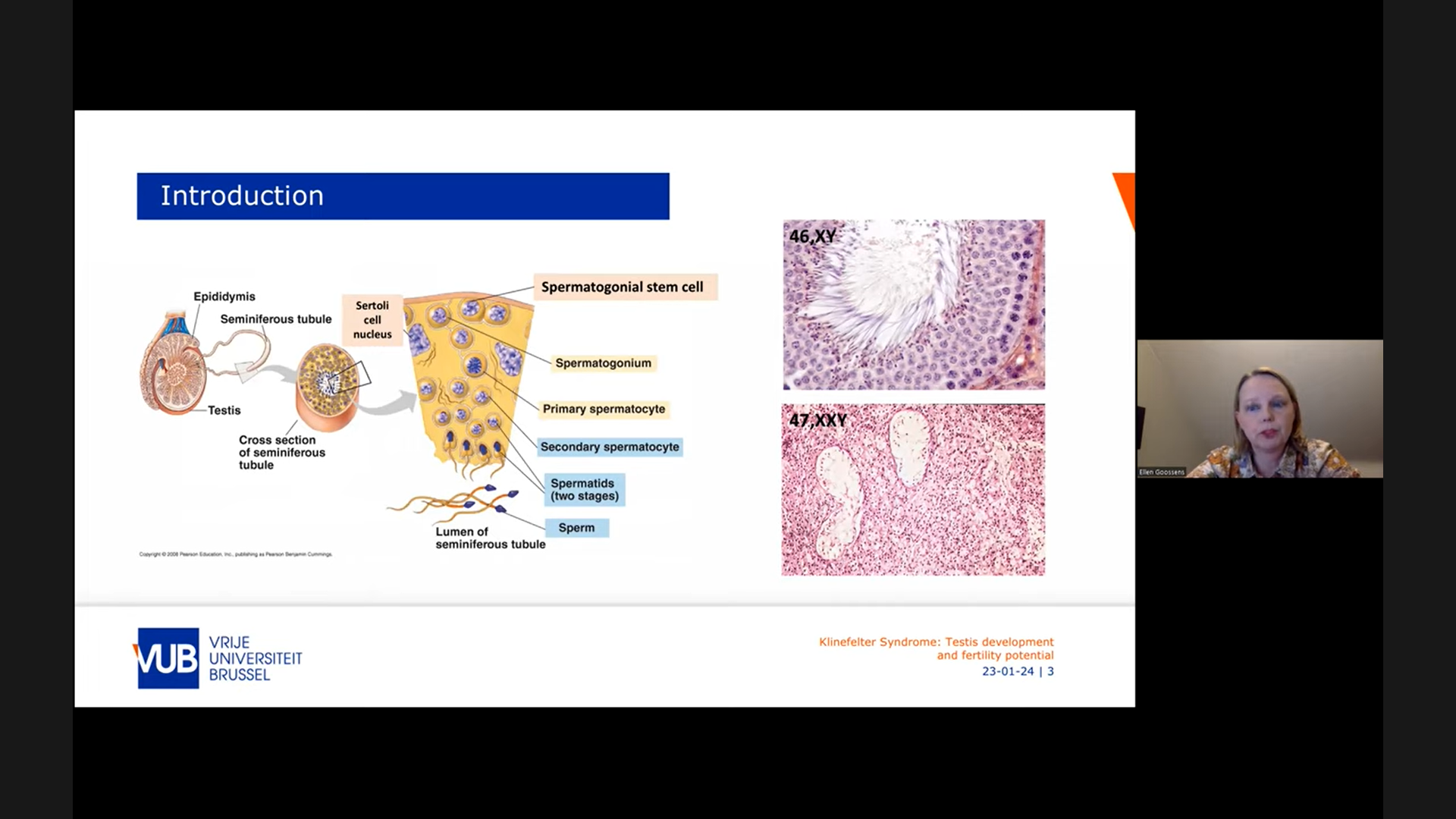 Klinefelter Syndrome - Testis Development And Fertility Potential 