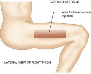 Vastus Lateralis Injection Site.webp