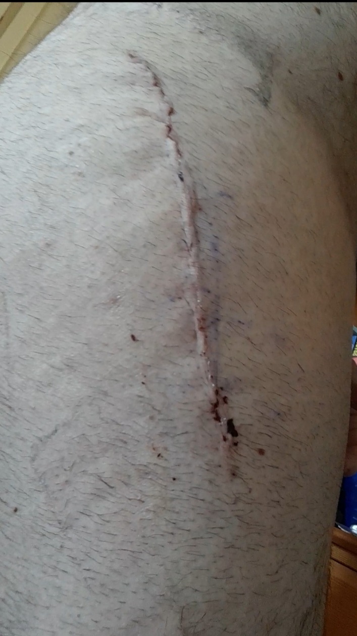 Wound_15_days_post_op.jpg