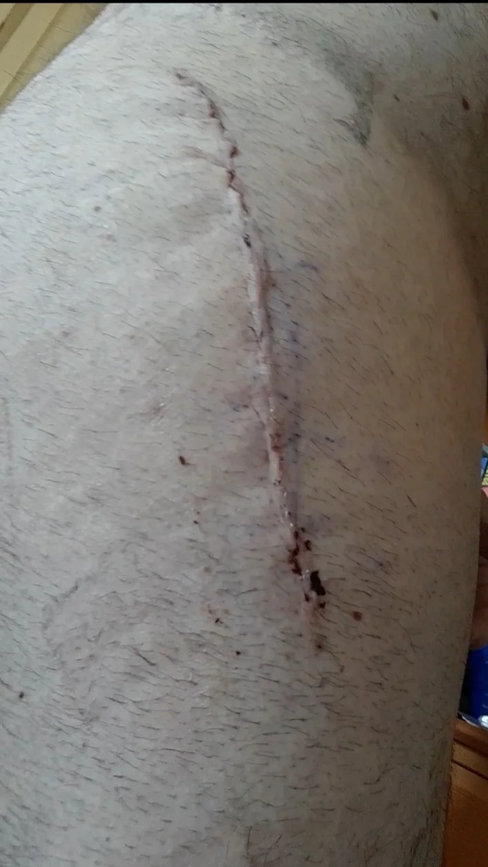 Wound_15_days_post_op.webp