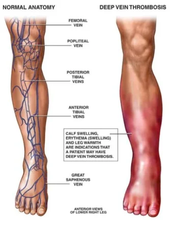 deep-vein-thrombosis.webp