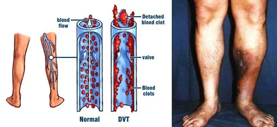 MVC-Miami-FL-March-is-DVT-Awareness-Month-Best-Vein-Doctor.webp