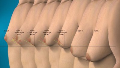 7kinds-gyno.jpg