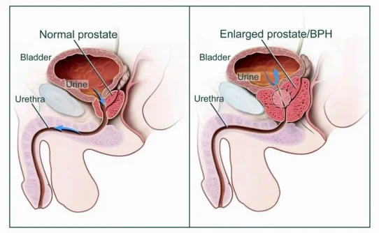 prostatenew.webp