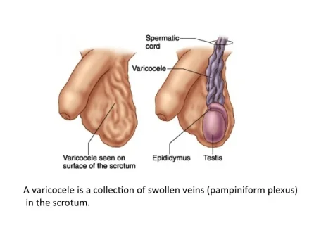 varicoles.webp