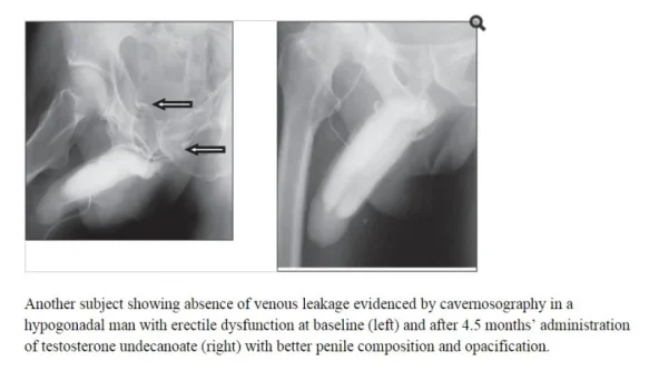 venous leakage.webp