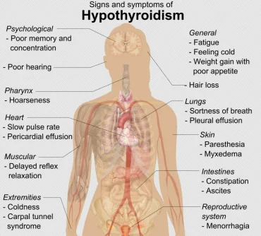 Signs_and_symptoms_of_hypothyroidism.png.webp