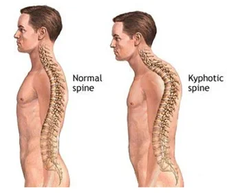 upper back curvature.webp