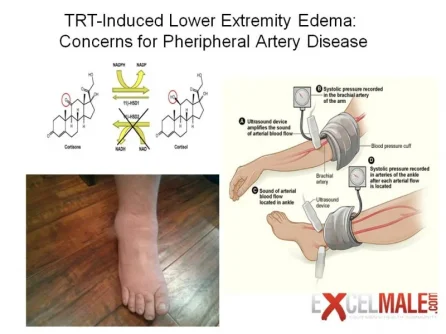 testosterone edema.jpg