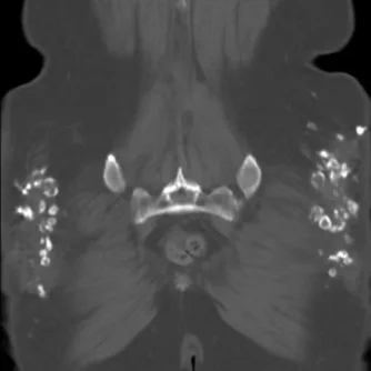 gluteal calcification following SQ injection.webp