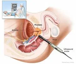 prostateultrasound.webp