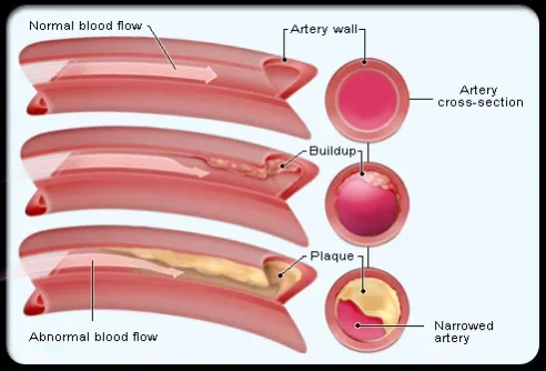 cholesterol_drugs_s2_cholesterol_illustration - Copy.webp