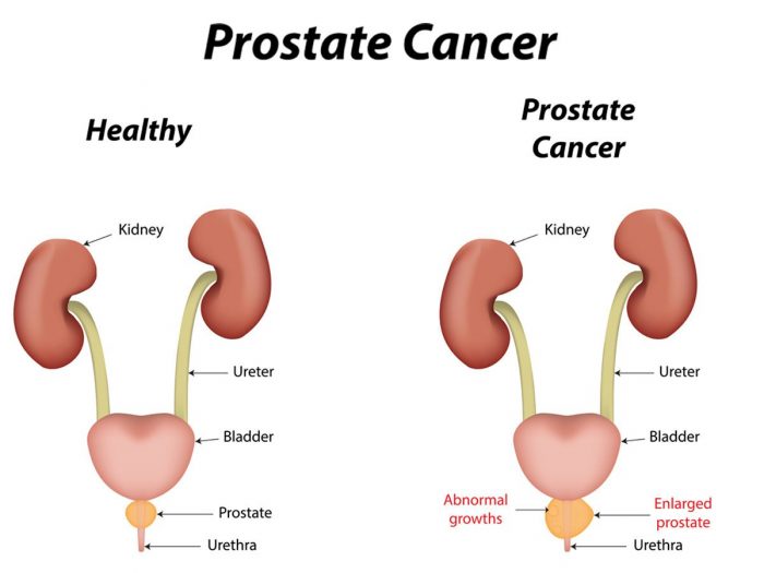 Shifting The Paradigm Of Testosterone Replacement Therapy In Prostate